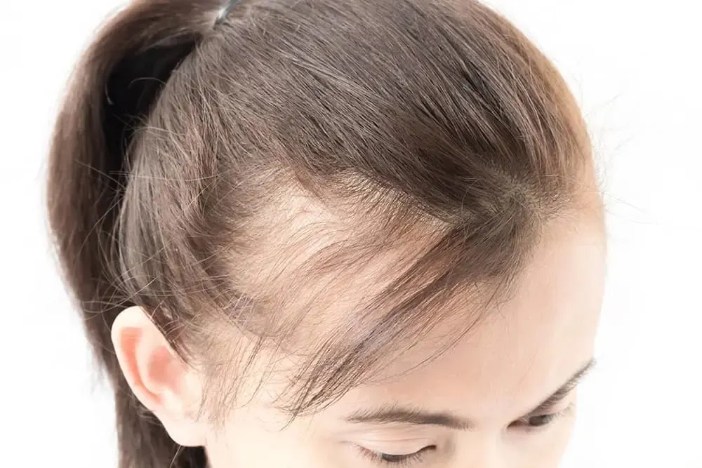 penipisan rambut