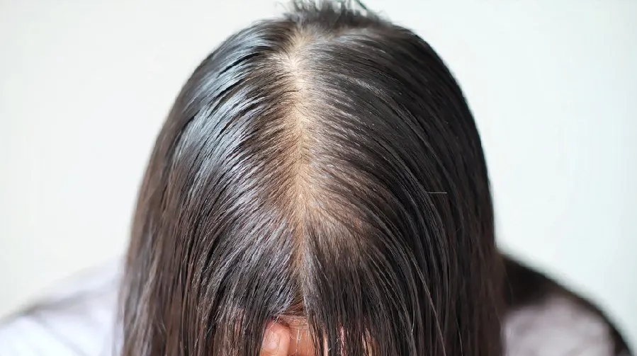 rambut menipis