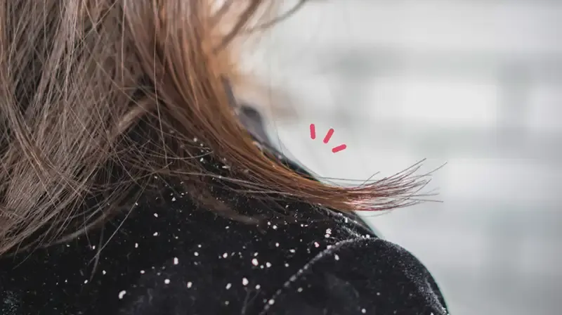rambut berketombe