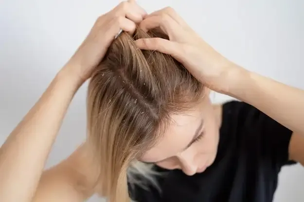 rambut ketombe