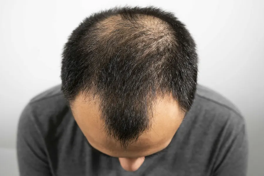 Alopecia Androgenetik
