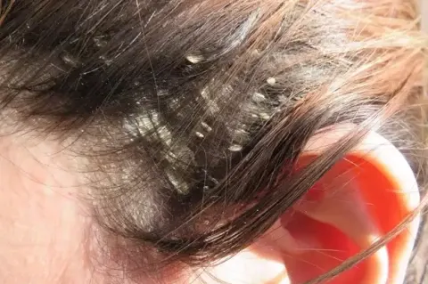 Scalp Ringworm