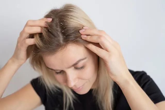 4 Tingkat Ketombe pada Rambut yang Wajib Kamu Kenali